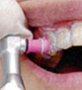 1.ホワイトニングについての説明、歯の表面をクリーニング